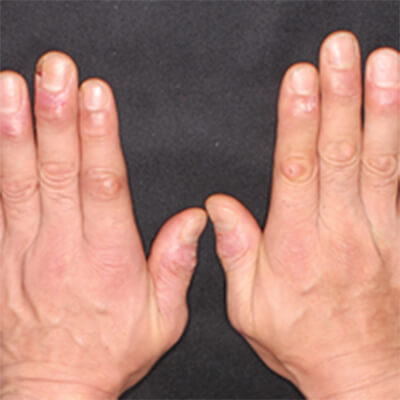 関節症性乾癬（乾癬性関節炎）の症状例